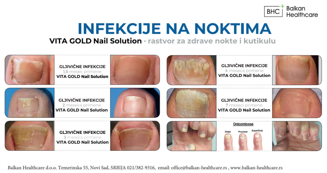 Vita Gold nail before abd after